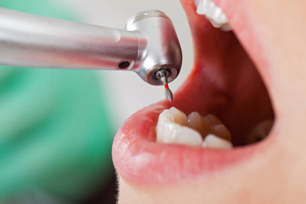 Best Emergency Wisdom Teeth Removal in Mccoll, SC